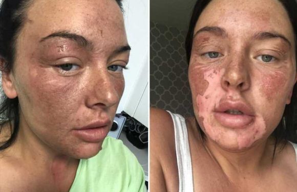 Mum suffers horrific facial burns after microwave egg poaching hack goes wrong and boiling water explodes all over her