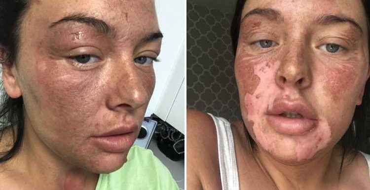 Mum suffers horrific facial burns after microwave egg poaching hack goes wrong and boiling water explodes all over her