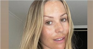 Kate Ferdinand admits she was ‘scared’ to post skin pictures as she opens up on melasma