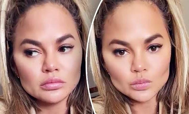 Chrissy Teigen had fat removed from her face with plastic surgery