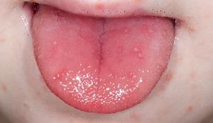 Children hit by wave of hand, foot and mouth disease – every parent needs to know these signs