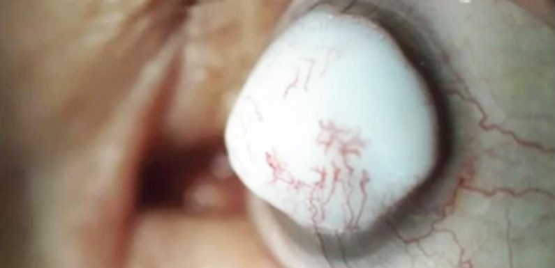 Grim photos show giant white lump growing on man's eyeball after cataract op