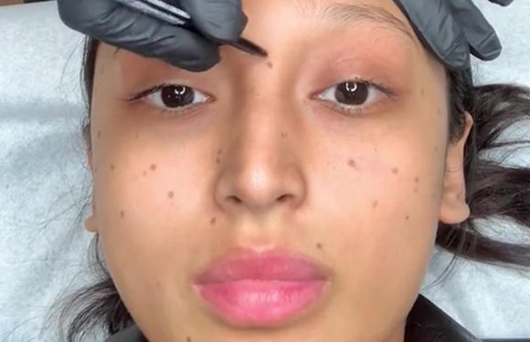 I got freckles tattooed onto my face because I wanted an unique look – people now say I look like I have chicken pox