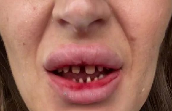 I flew to Turkey for ‘Hollywood smile surgery’ – it went horrifically wrong, I’ve been left with barely any teeth