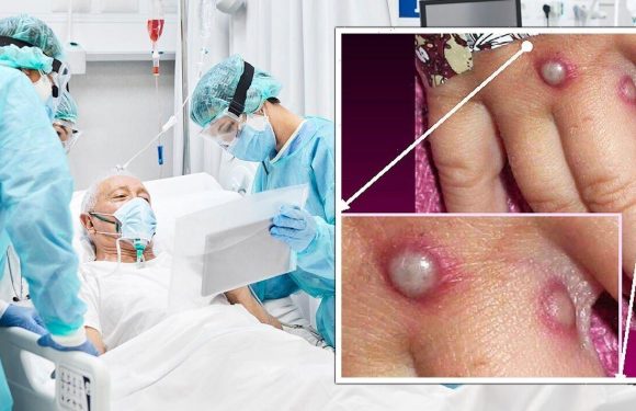 ‘Get masks while you can’ Dr’s horror monkeypox warning over ‘disease with 10% mortality’
