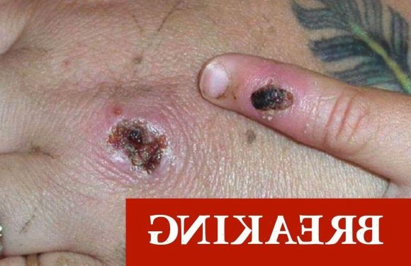 Monkeypox warning: Two in London diagnosed with rare infection, UK health chiefs confirm