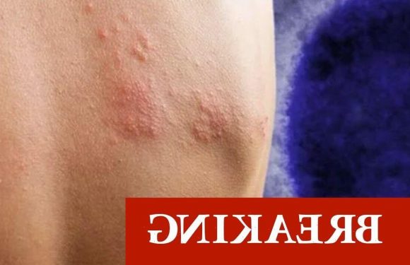 Now Monkeypox hits the US – deadly virus crosses Atlantic after two UK cases confirmed