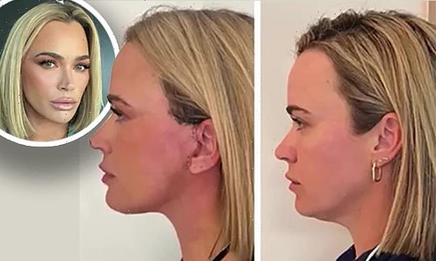 Teddi Mellencamp, 40, shares before and after photos of her neck lift