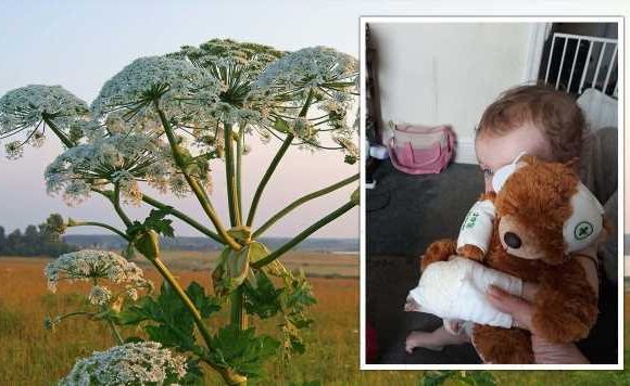 ‘Never seen a child so badly burned’ Father’s warning about UK’s ‘most dangerous plant’
