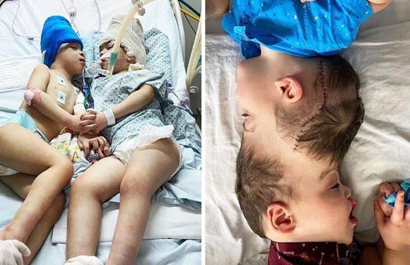 Great Ormond Street doctors separate twins joined at head in incredible 27-hour operation