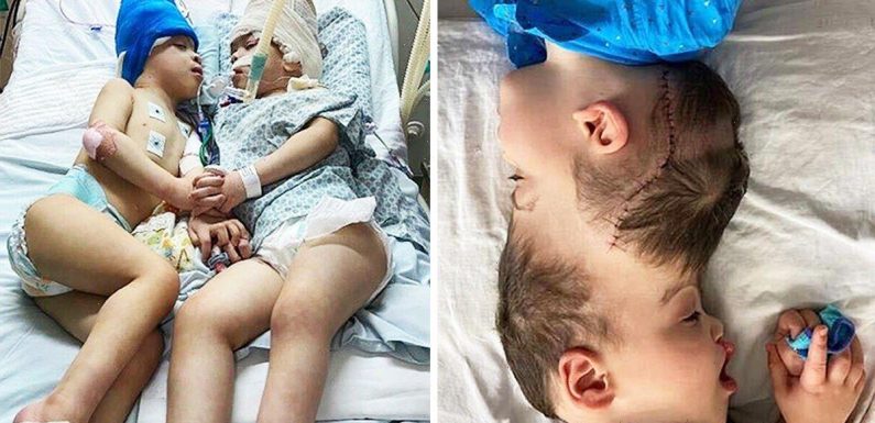 Great Ormond Street doctors separate twins joined at head in incredible 27-hour operation