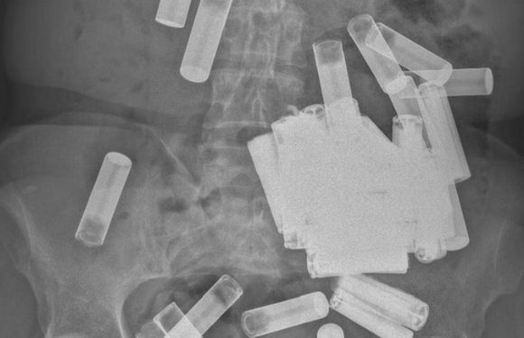 Woman had 55 batteries in her bum and stomach – doctors say it’s ‘most ever’