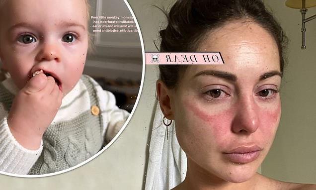 Louise Thompson shares picture of 'horrendous' rash