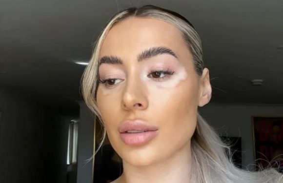 Towie’s Demi Sims strips topless in unfiltered photo as she celebrates her vitiligo | The Sun