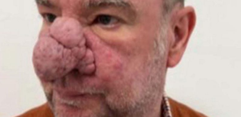 ‘Elephant man’ celebrating Christmas after life-changing treatment for deformity