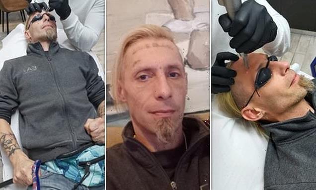 Homeless man paid by stag party to get a tattoo is having it removed