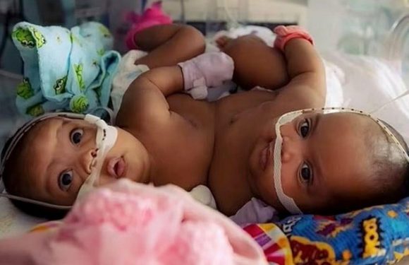 Conjoined twins attached at stomach successfully separated after 11-hour surgery