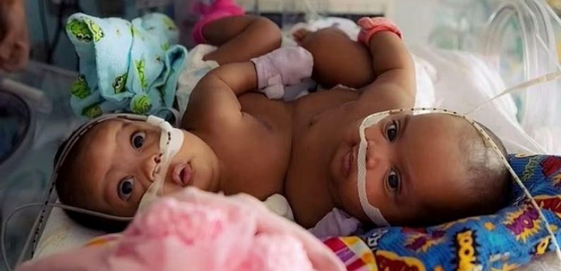 Conjoined twins attached at stomach successfully separated after 11-hour surgery