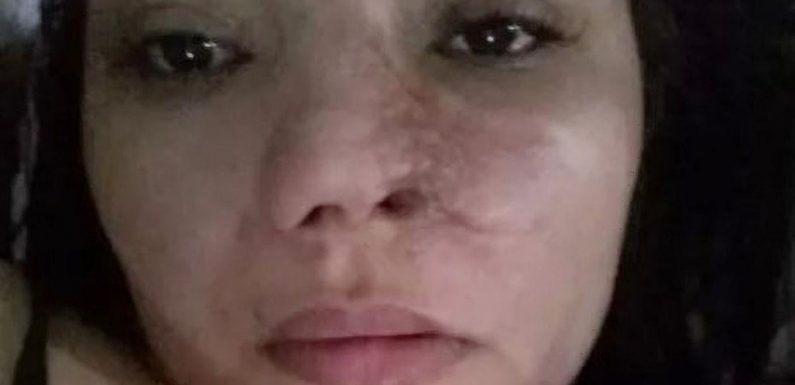 Dentist’s botched operation leaves woman’s nose slowly rotting off her face