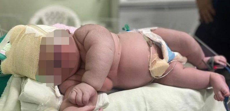 Docs stunned after delivering huge 7kg baby that’s the size of a one-year-old