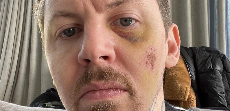 Professor Green nearly died after falling into steel and concrete during seizure