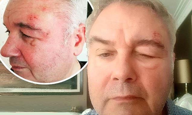Eamonn Holmes claims stress of £250k tax row caused bout of shingles