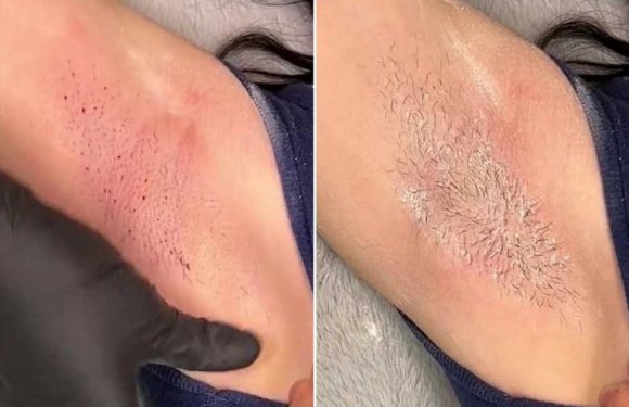 I'm a waxer and you shouldn’t be worried if you bleed during a treatment, it’s actually a really good thing | The Sun