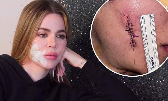 Khloe Kardashian gives first look at stitches after skin cancer scare