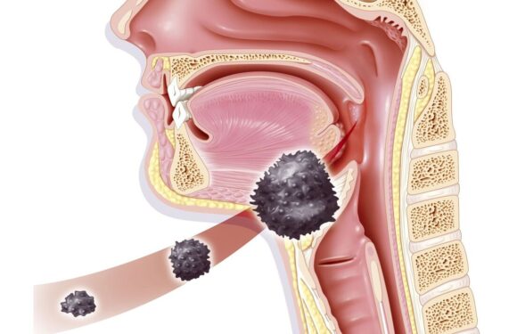 Surge in throat cancers in the West linked to oral sex