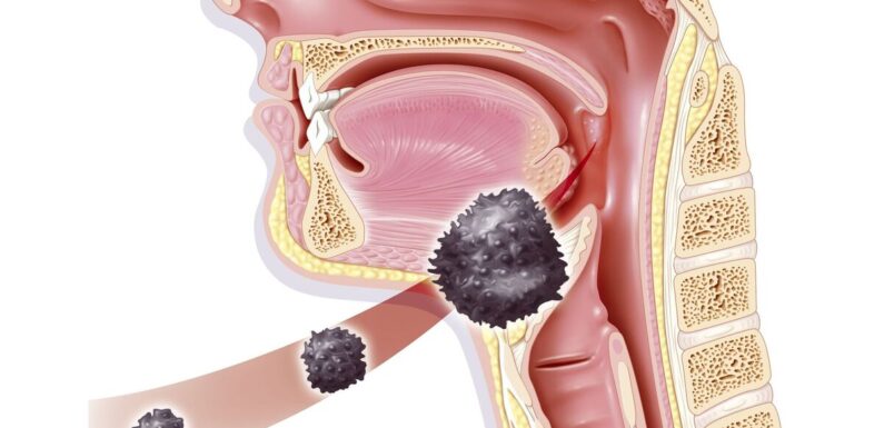 Surge in throat cancers in the West linked to oral sex