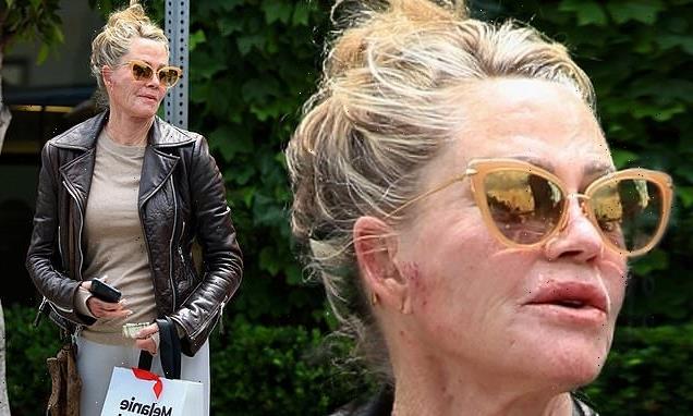 Melanie Griffith, 65, displays bruises on hand and face