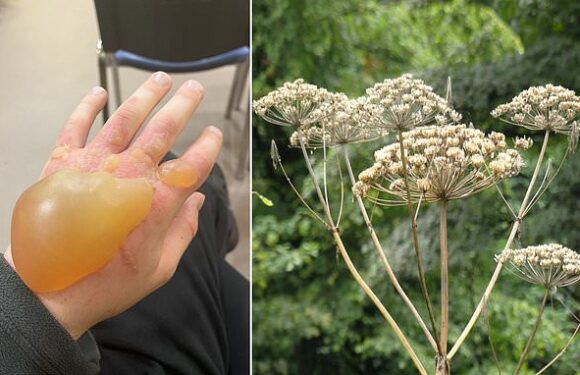 Britain's 'most dangerous plant' leaves teen with HUGE blister