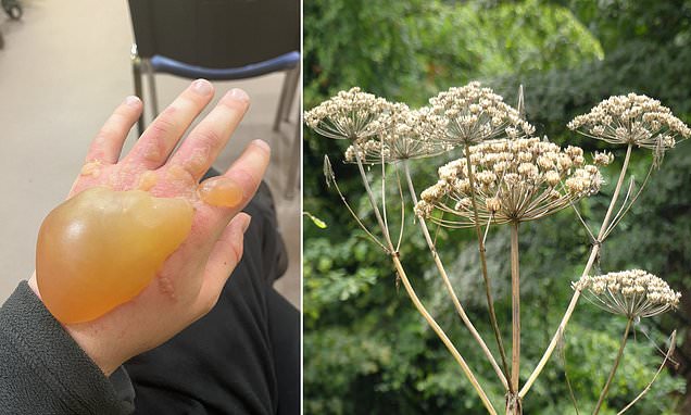 Britain's 'most dangerous plant' leaves teen with HUGE blister