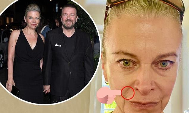 Ricky Gervais' partner Jane Fallon cries over skin cancer scare