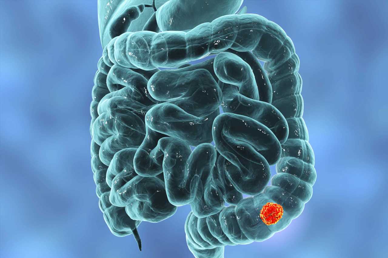 The little-known symptom of bowel cancer you might spot walking around the house | The Sun