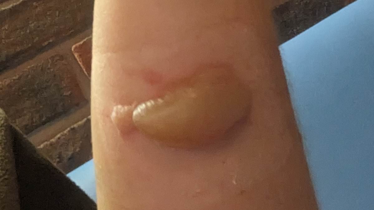 Gardener left with painful blisters after rubbing cow parsnip on arm