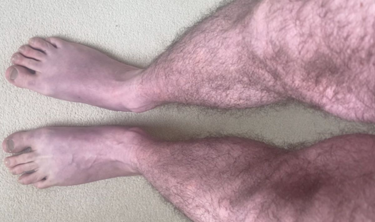 The strange and ‘striking’ symptom of Long Covid doctors want you to be aware of