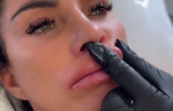 Katie Price left weeping with pain as she has filler in her giant lips dissolved – and shows fans the results | The Sun