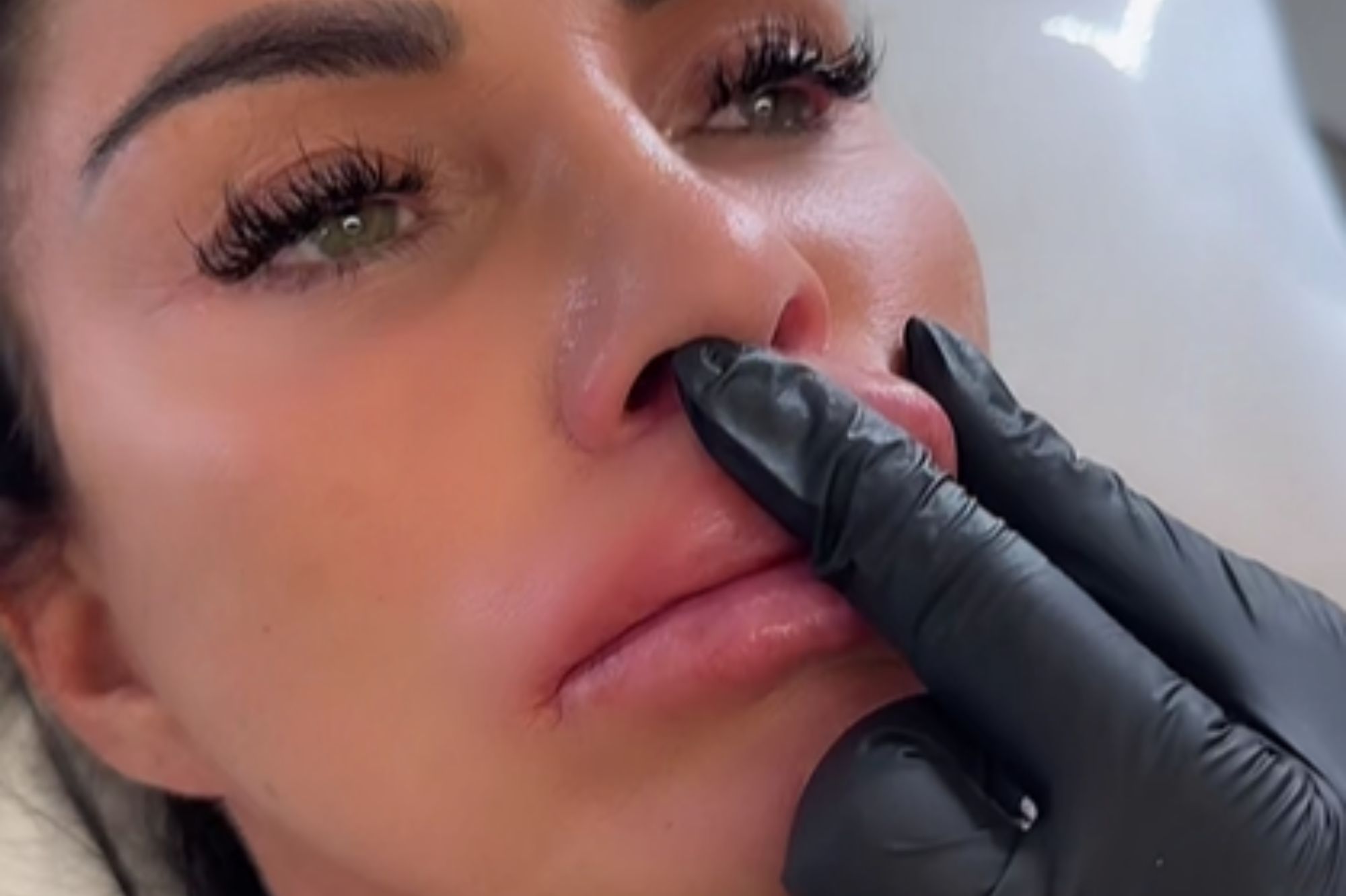 Katie Price left weeping with pain as she has filler in her giant lips dissolved – and shows fans the results | The Sun