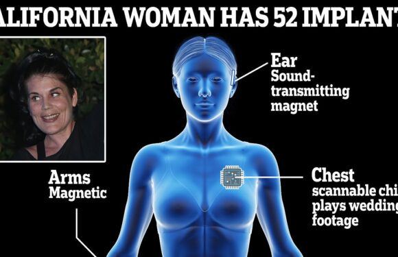 The world's ultimate cyborg! California woman has 52 implants